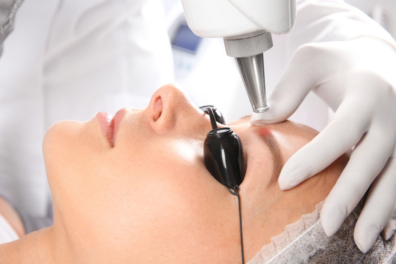 PMU Laser Removal