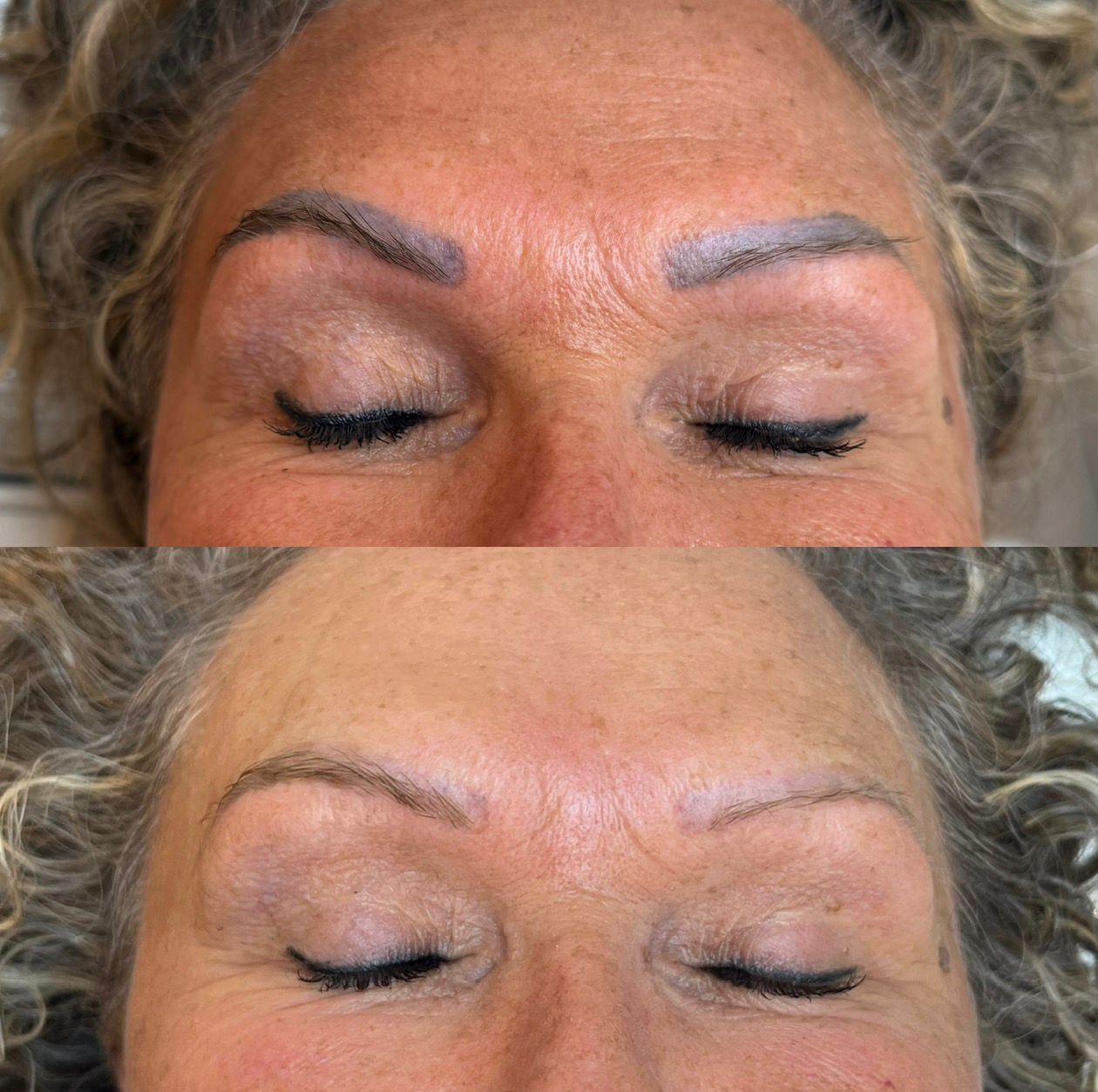 Laserverwijdering Resultaat Midden