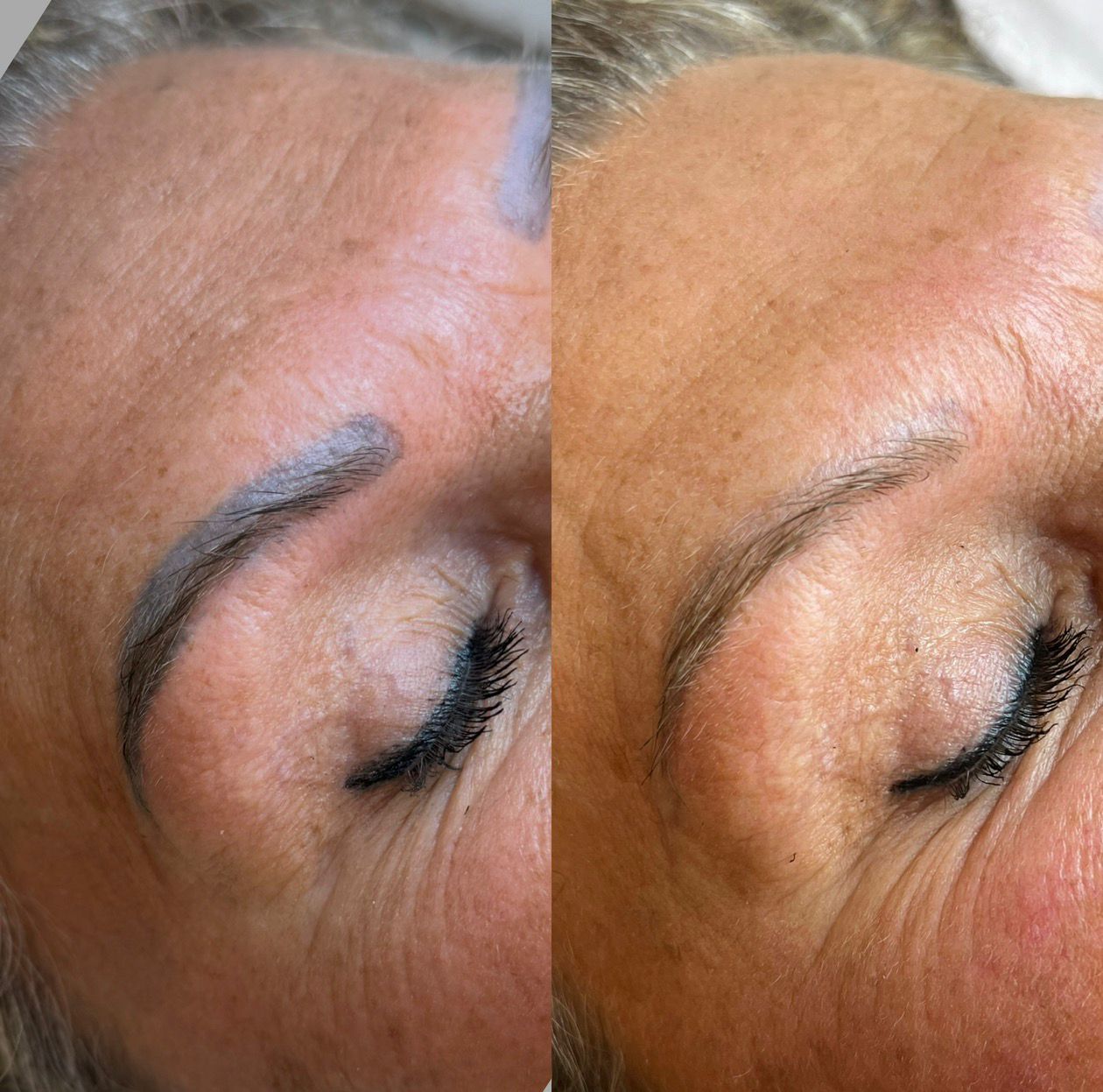 Laserverwijdering Resultaat Boven